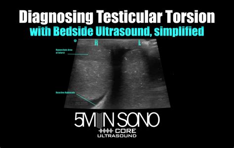 test killer torsion|testicular torsion ultrasound results.